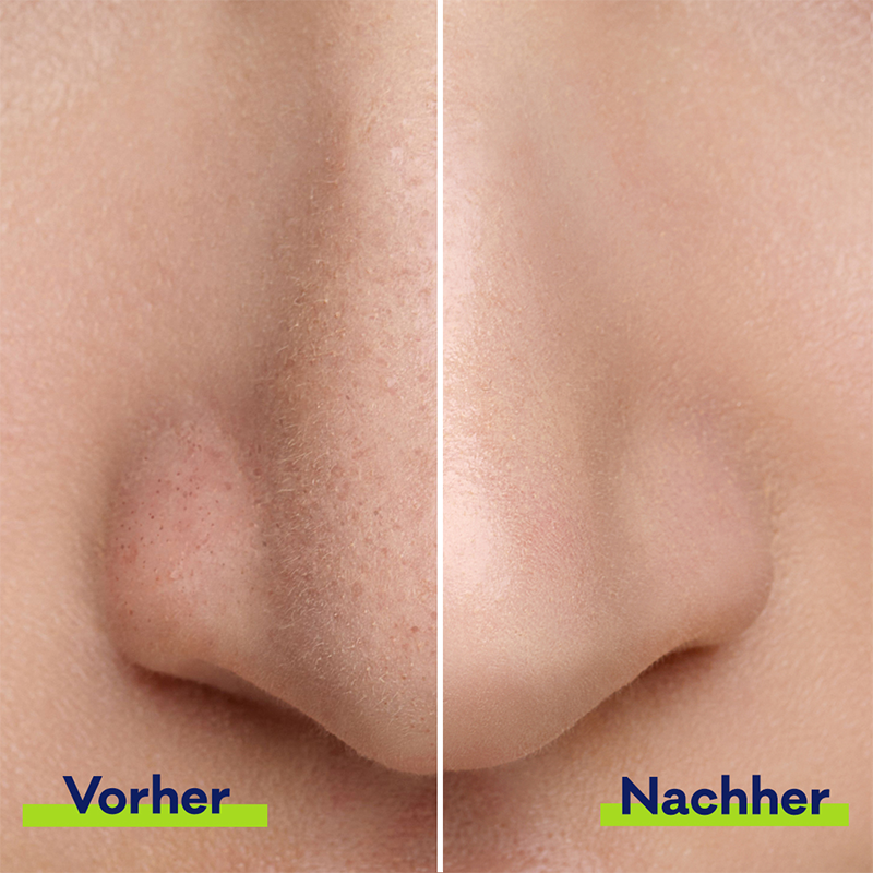 Porenverfeinernde Bubble Nasenmaske