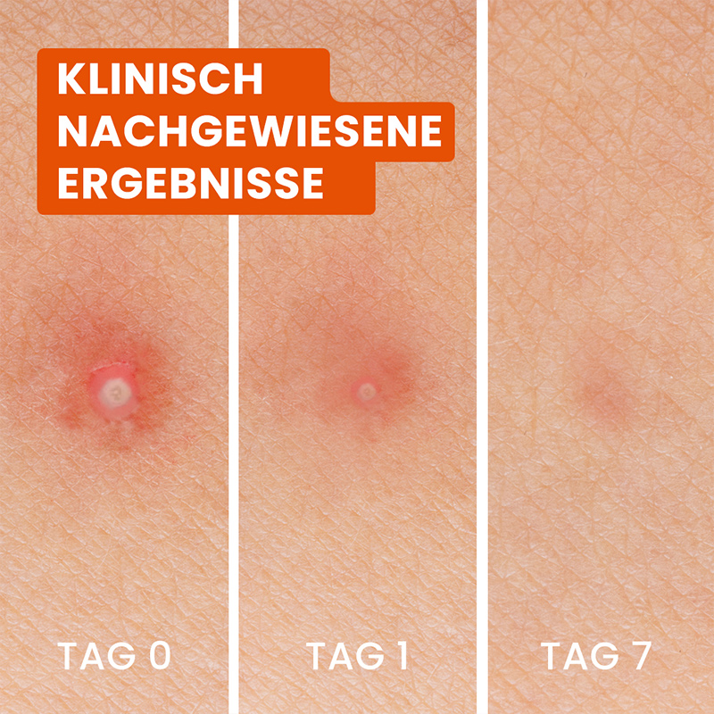 Anti-Pickel Patches 3in1