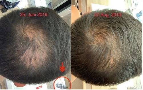 Haarwuchs-Tonic-before-after