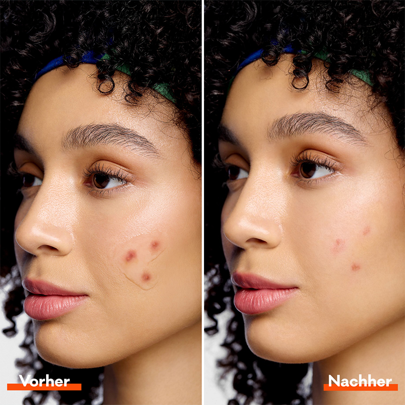 Anti-Pickel-Unsichtbares-Peel-Off-Gel-Vorher-Nachher